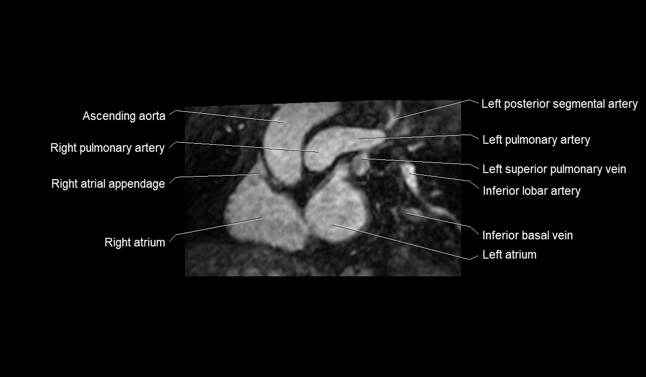 MRI heart and coronary arteries short axis anatomy image 12.webp